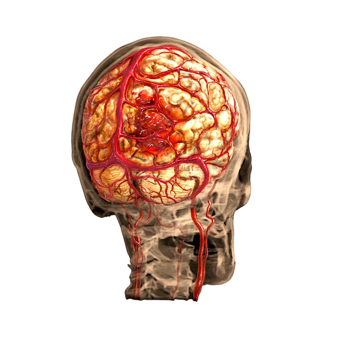 Stroke
