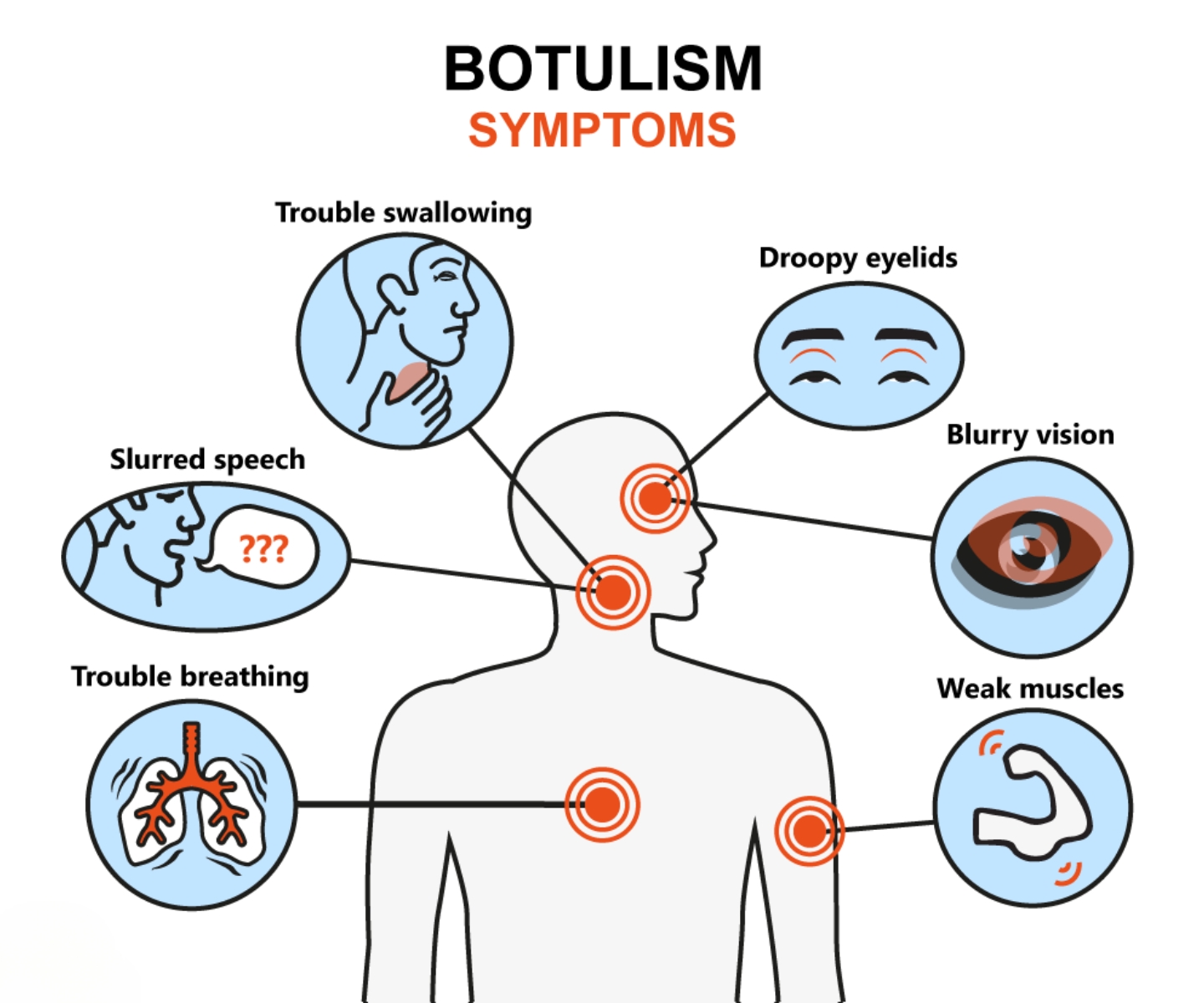 Botulism Toxin Disorder