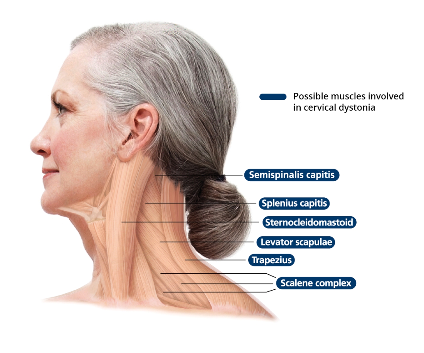 Cervical Dystonia