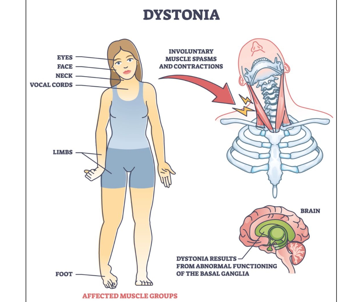 Dystonia