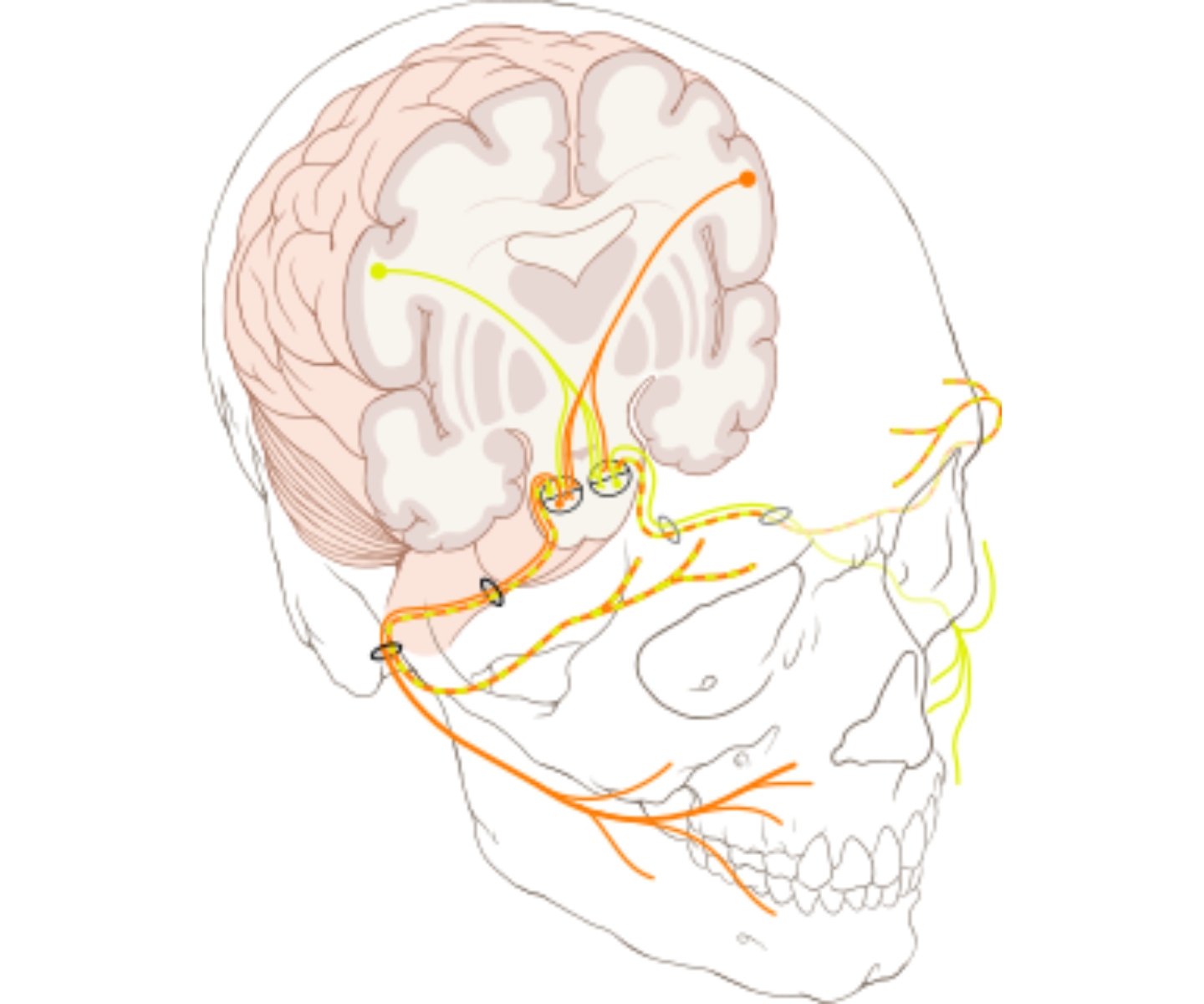 Hemi masticatory Spasm