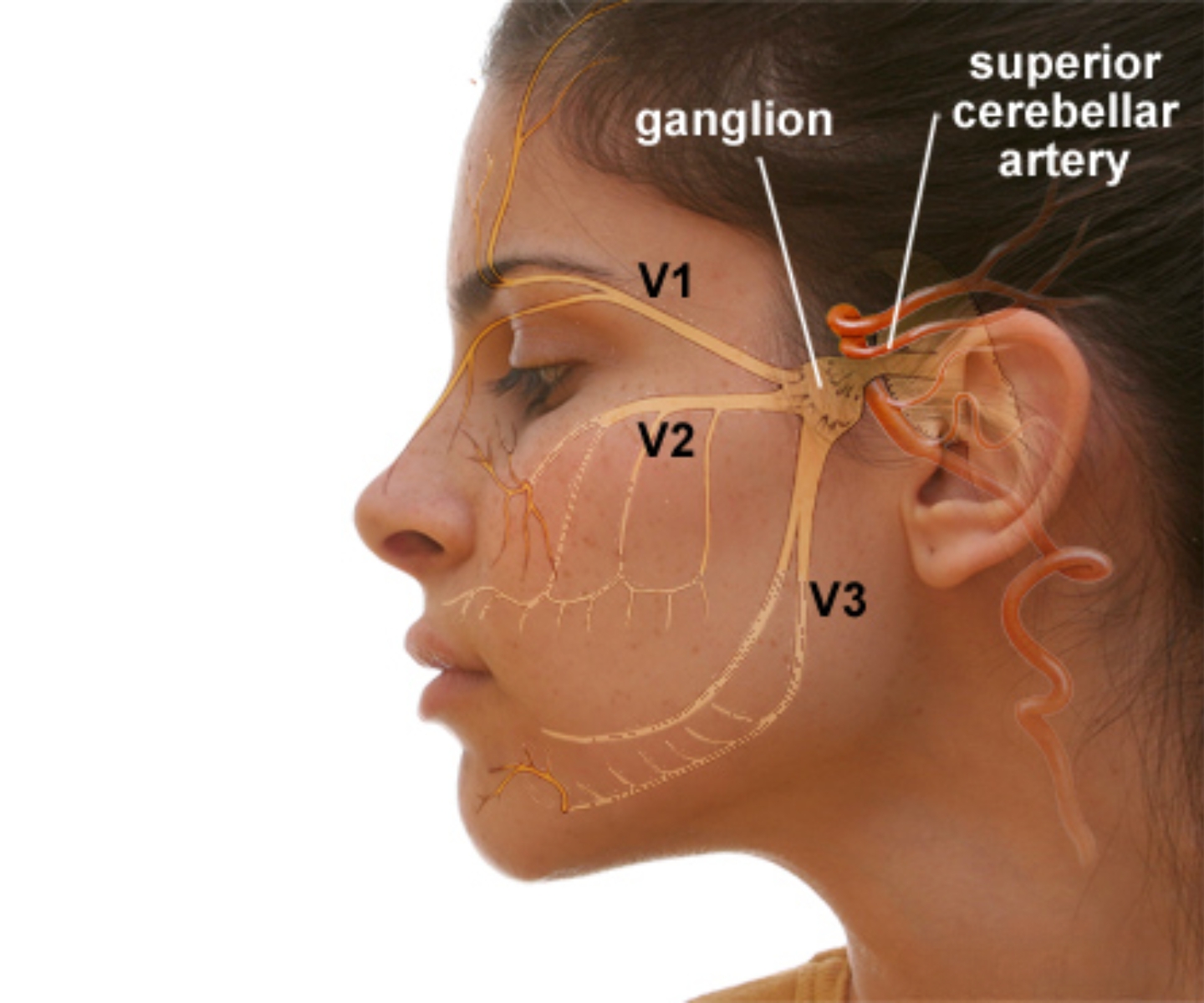 Hemifacial Spasm