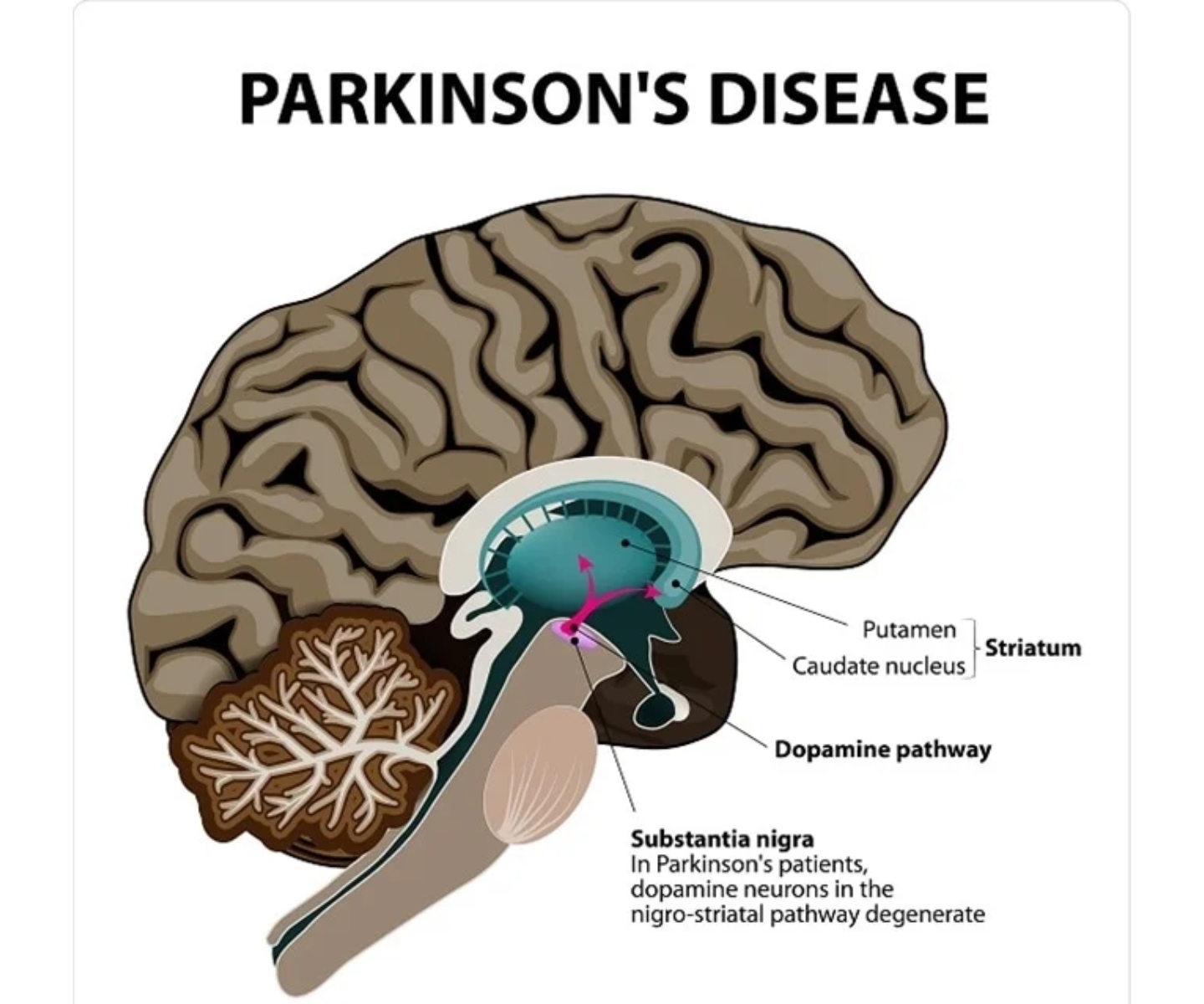 Parkinson's Disease
