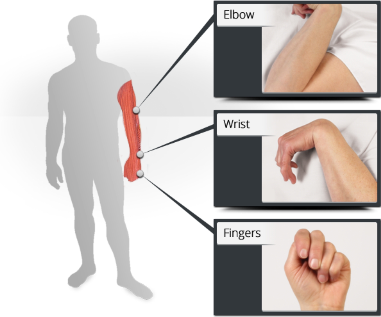 Post Stroke Spasticity